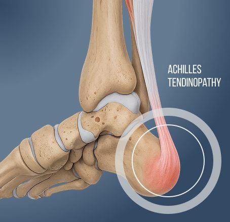 Achilles pain physiotherapy assessment in Nicosia