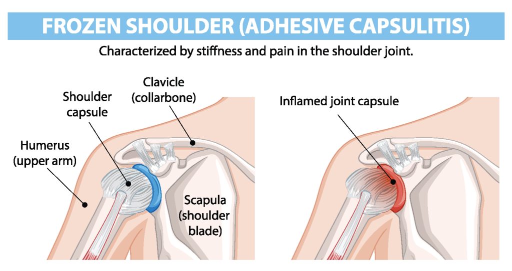 Shoulder rehabilitation physiotherapy in Strovolos Nicosia