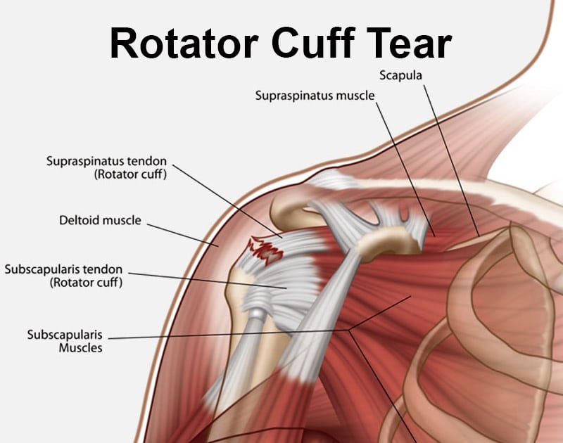 Rotator cuff rehabilitation physiotherapy in Strovolos Nicosia