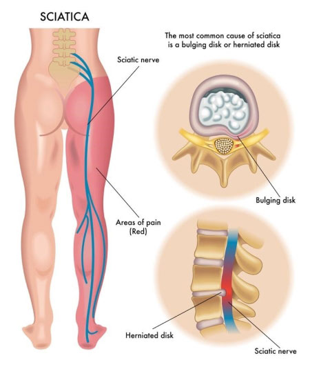 Sciatica treatment and physiotherapy in Nicosia