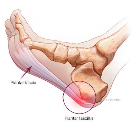Heel pain physiotherapy assessment in Nicosia