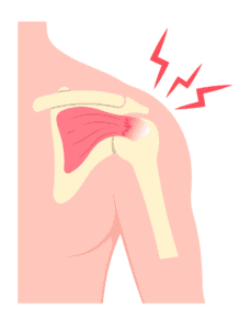 How Physiotherapy Helps Shoulder Impingement Elinos Petrou