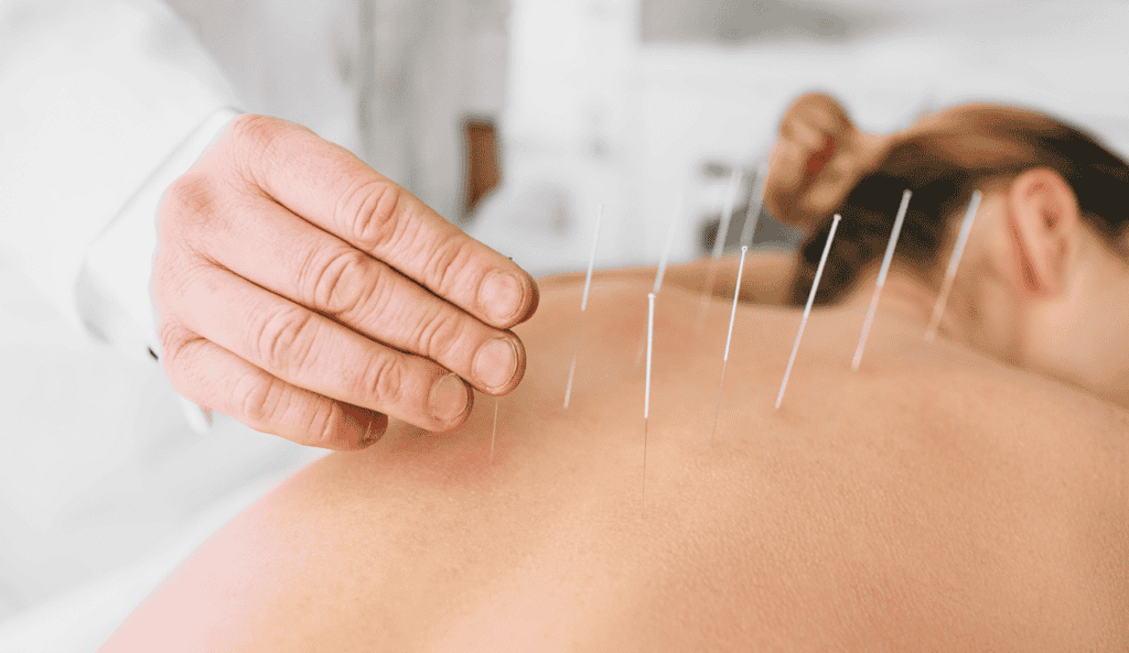 woman with dry needle on the back