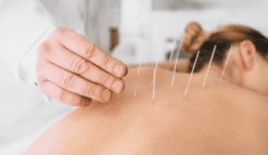 woman with dry needle on the back