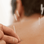 how it the needle look when you use it for acupuncture for back pain