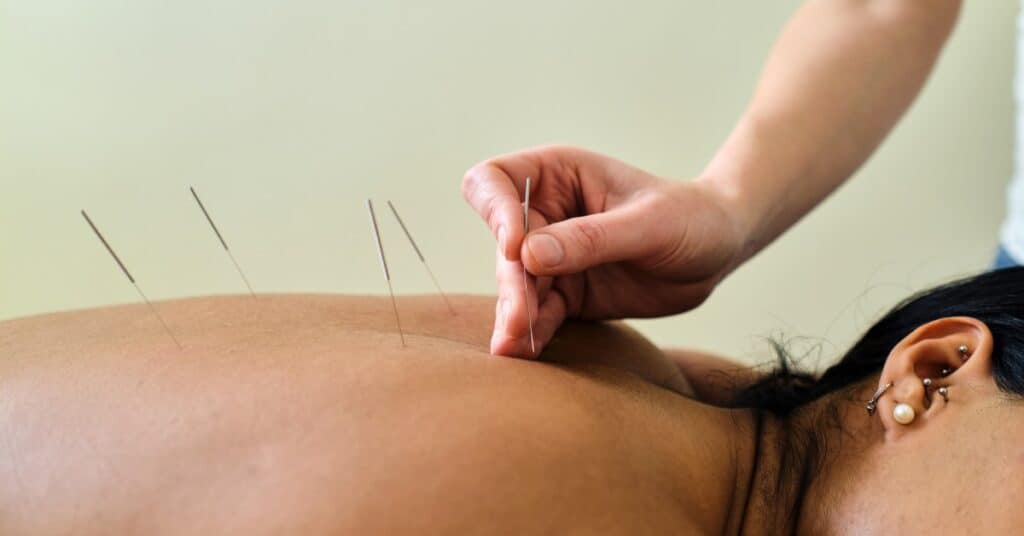 the way to put needles when you want acupuncture for anxiety