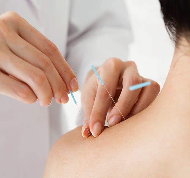inserting needles for acupuncture for anxiety