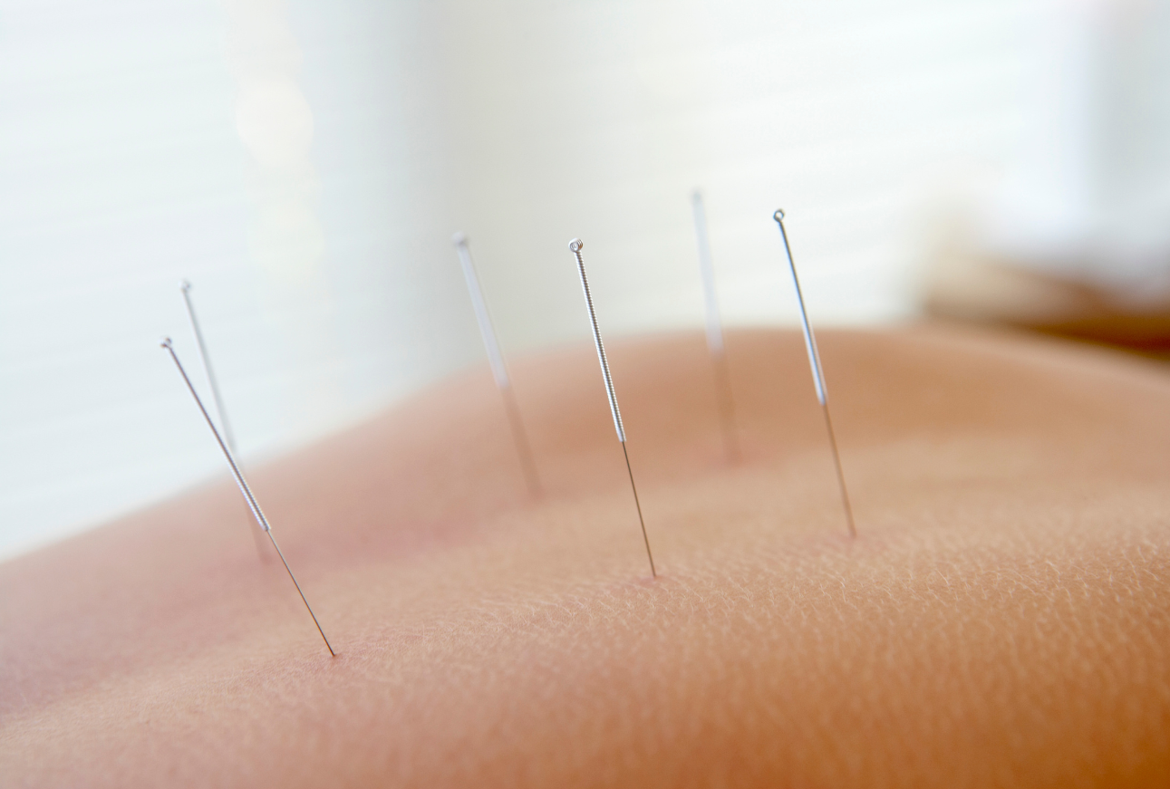 acupuncture in Nicosia