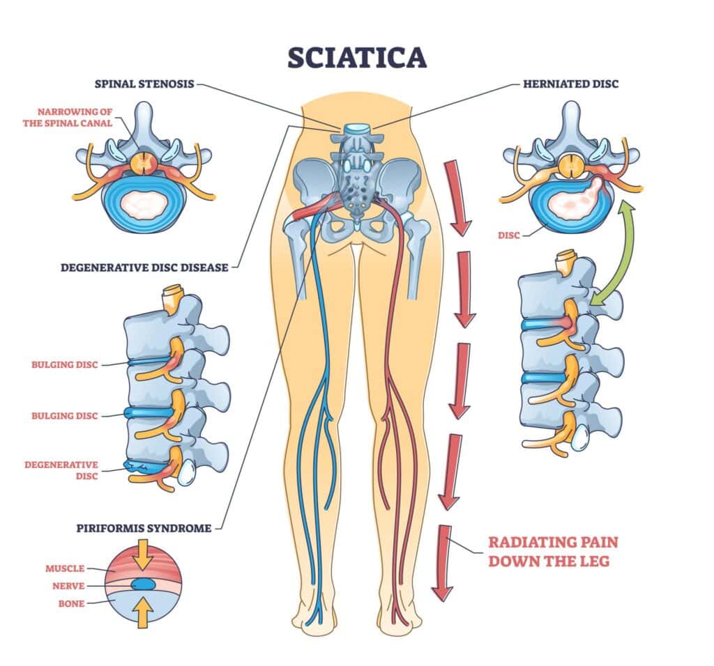 lower back pain , physiotherapy Gesy